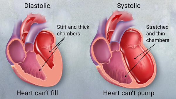 Congestive Heart Failure Explained – Central Georgia Heart Center