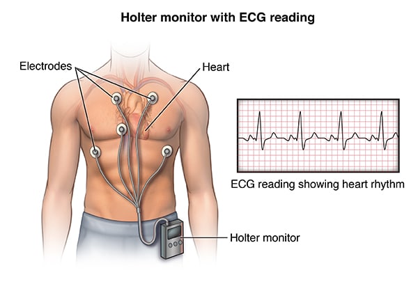 what-is-holter-monitoring-central-georgia-heart-center