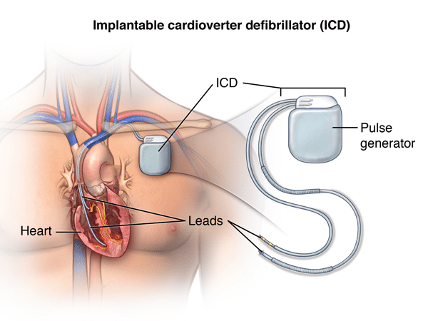 cardiac defibrillator