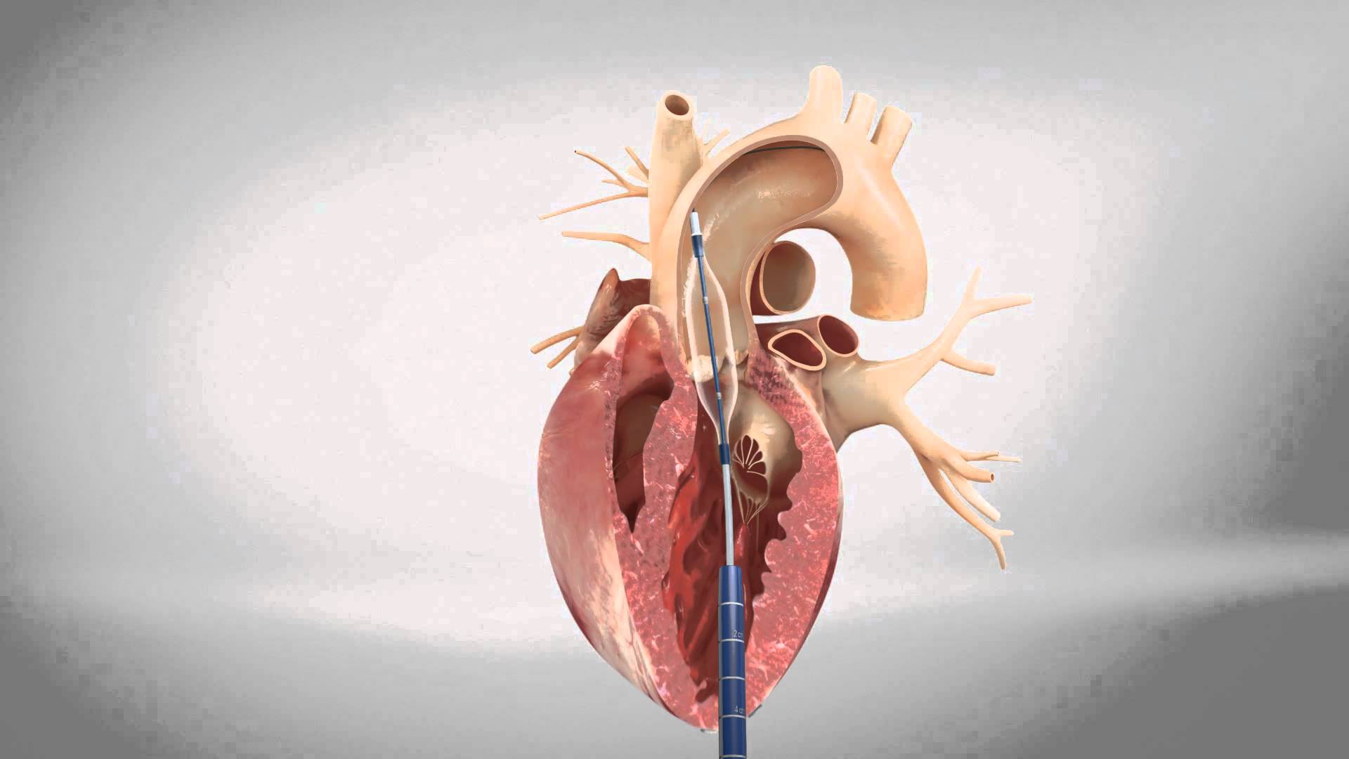 Undertsanding A Transcatheter Aortic Valve Replacement (TAVR) - Central  Georgia Heart Center